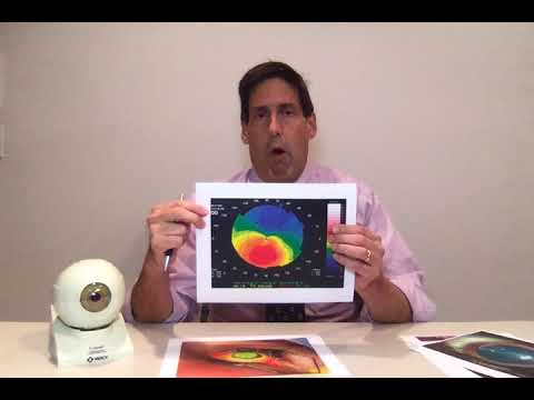 What is Keratoconus and how to treat it | Dr. Alan Mendelsohn