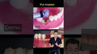 Digital dental implants by top dentist Delhi
