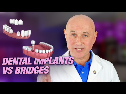 Implants vs Bridge Work: Which Is Best for You? - Expert Insights from Dr. Dmitry Gorbatov