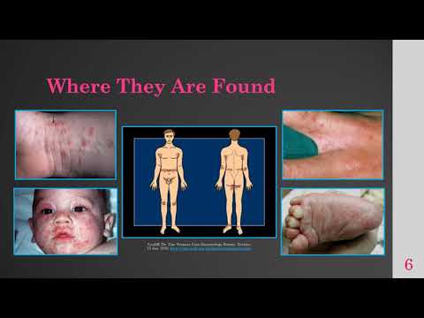 Scabies video