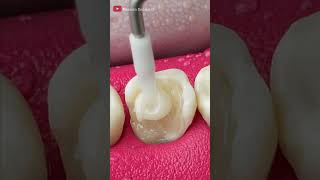 Unbelievable Tooth Restoration #asmr #restoration