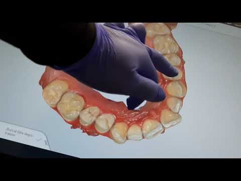 Computational Photography in Dentistry (3D Dental Scan)