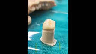 Zirconia Crown | Digital Impressions | iTero 5D Scan #dentist #digitaldentistry #itero
