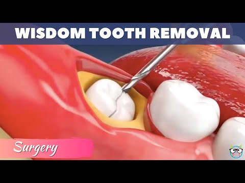 Wisdom teeth removal / Wisdom teeth extraction / Tooth extraction animation