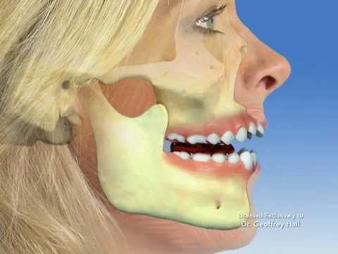 TMJ - Temporomandibular joint dysfunction