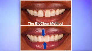 The Bioclear Method can help diminish spacing in your smile!