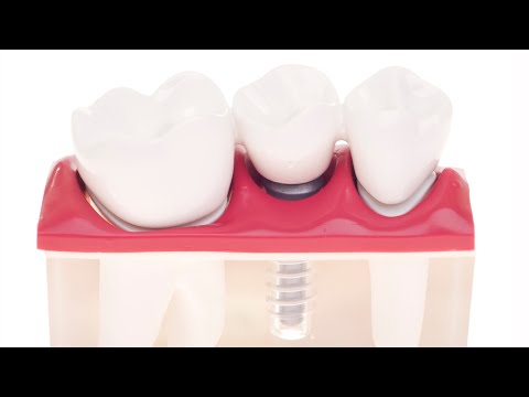 Dental Implants - Tooth Replacement - Monroe, NC - Mint Hill, NC