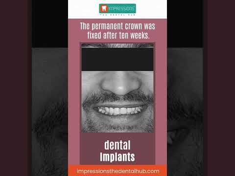 Dental implant | Impressions The Dental Hub
