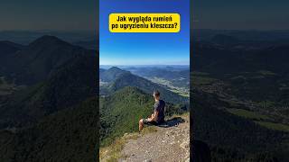 Jak wygląda rumień po ugryzieniu kleszcza? #shorts #kleszcze #zdrowie #choroby