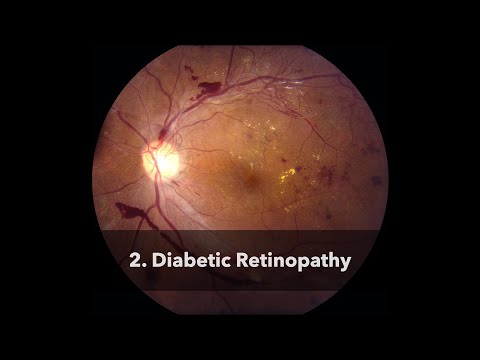 Diabetic Retinopathy