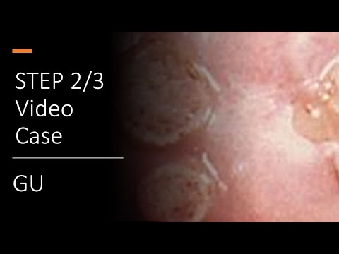 GU STEP 2 Case + Explanation (Case 4)