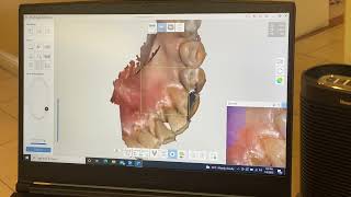 How To Take Digital Impression For Crown Using Medit500