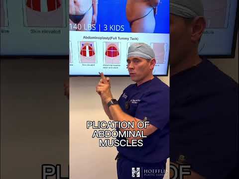 What are the steps involved with tummy tuck surgery? 🤔 #shorts #plasticsurgery #tummytucksurgery