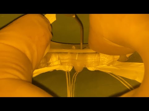 Injection Molding of Composite Material to Restore Worn Lower Central Teeth under Rubber Dam