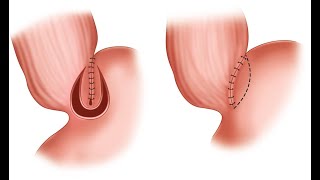Esophagomyotomy CPT code - simplify medical coding