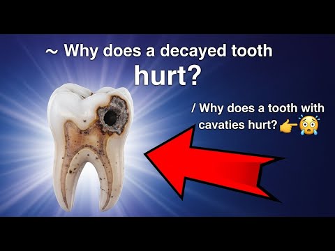 ✅ Why does a decayed tooth hurt? / Why does a tooth with cavities hurt? 👈😳