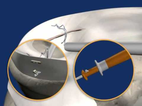 FAST FIX 360 ANIMATION - Smith & Nephew