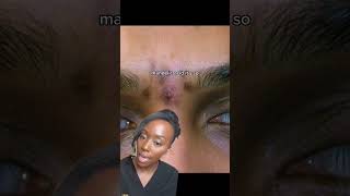 How to Fade Acne Spots: Treating Post Inflammatory Hyperpigmentation.