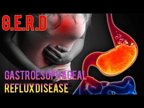 What is G.E.R.D or Gastroesophageal Reflux Disease