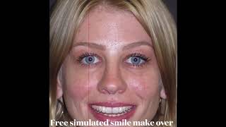 Bioclear Uveneers | Same Day Smile | Learn How It's Done with No Grinding