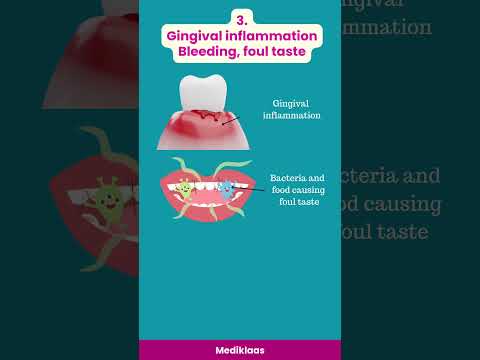 Sequel of Food impaction #gumdisease #periodontaldisease #caries