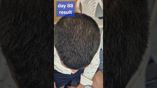 Fast hair growth #hairgrowth #haircare #minoxidil #hair #minoxidilresult
