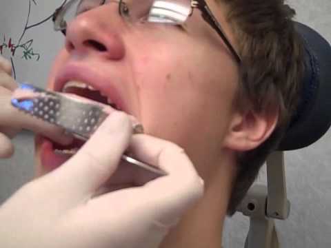 Dalton gets his braces off at Davis & Davis Orthodontics!