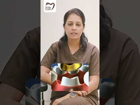 Why crawn required after rootcanal treatment? #rootcanaltreatment #dentalcare  #dentist