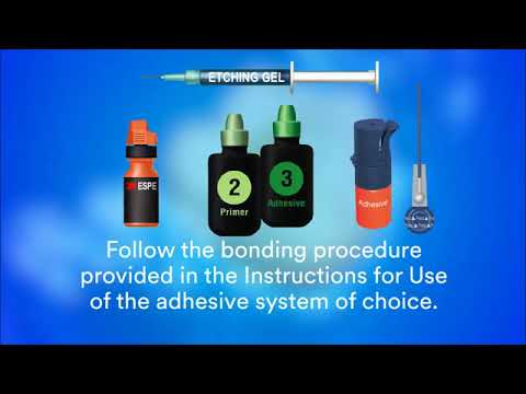 Single Shade Layering Technique for Posterior Restorations with Filtek Supreme XTE