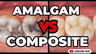 Amalgam vs Composite fillings - ALL REVEALED