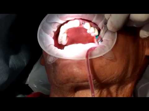 Dio Navi Navigation Implant assisted Sinus Lift
