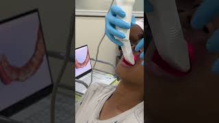 INTRORAL SCAN for accurate measurement #aligners#noimpression