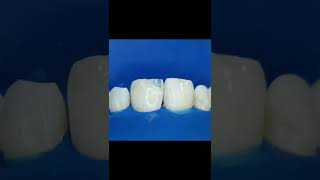 Class IV composite restoration