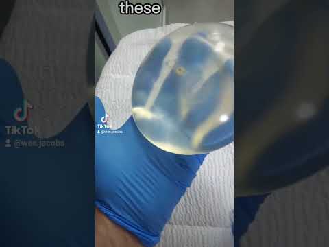 Breast Implant Replacement Surgery in San José, Costa Rica.