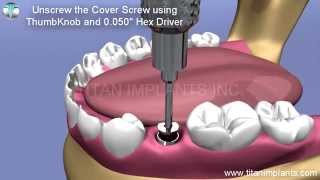 Restore TG Hex Abutment for Screw Retained Crown