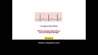How to read ECG for arrhythmia - In a song!