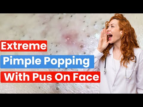 Extreme Pimple Popping with Pus on Face – The Most Addictive Pops Ever |Pimple Spa