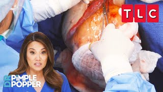 Dr. Lee Pops a BOWLING BALL-Sized Bump! | Dr. Pimple Popper | TLC
