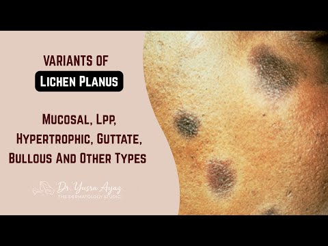 Lecture 2: Variants of Lichen Planus: Oral, Genital, LPP, Hypertrophic, Bullous & Rare Types