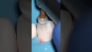 Step by step finishing and polishing of composite restorations. #composite #compositerestoration