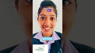 Gummy smile correction #orthodontics #gummysmile #smilecorrection