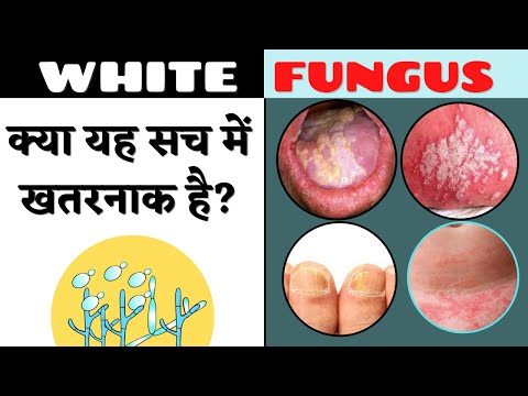 White fungus (Candidiasis) / What is white fungus and how deadly it is? / White fungus kya hai
