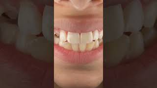 Sentral direct camposet filling #dentist #dentistry #dentalart #dentalwork