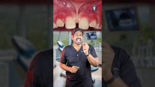 இந்த தசையை வெட்டினால் என்ன ஆகும்? Do Frenum Have Nerves? | Dr. Karthikeyan | Denta Kings