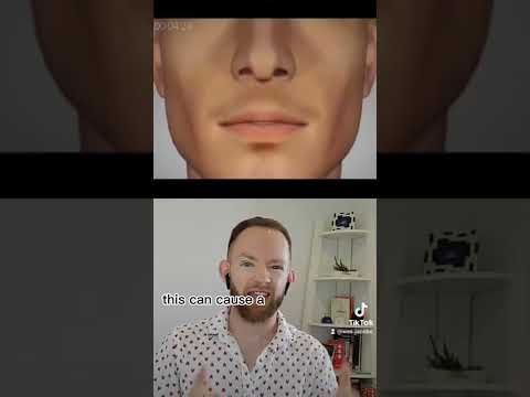 Bone loss due to missing teeth.