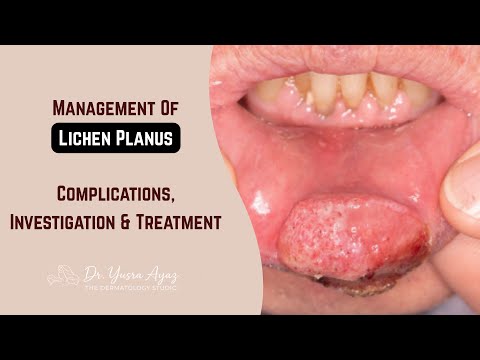 Lecture 3: Lichen Planus Complications & Management: Hair, Nail, Oral + Biopsy & Dermoscopy Guide