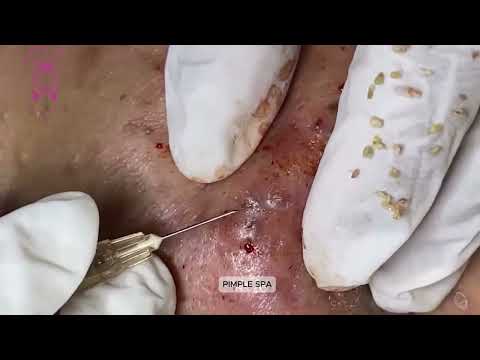 Satisfying Acne Removal (Pimple & Blackhead Extraction)