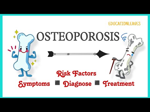 Osteoporosis: Risk Factors, Symptoms, Diagnose, & Treatment