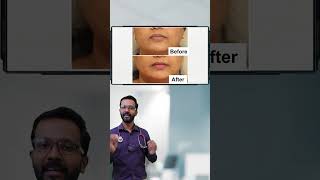 എന്താണ് Smile Correction | Smile Correction treatment #botox  #smilecorrection