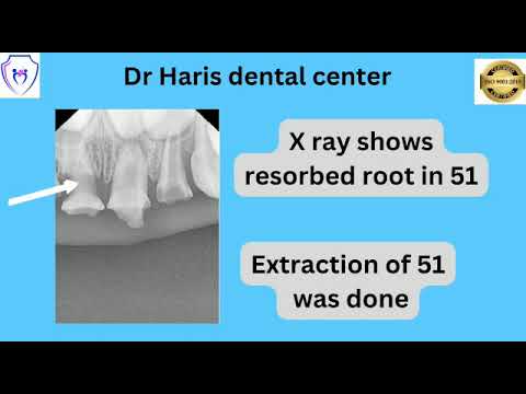 Custom made zirconia crown with cantilever in pediatric dentistry